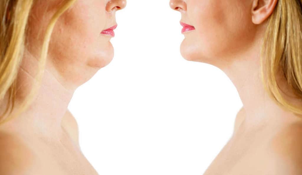 Double Chin treatment Basingstoke before and after results