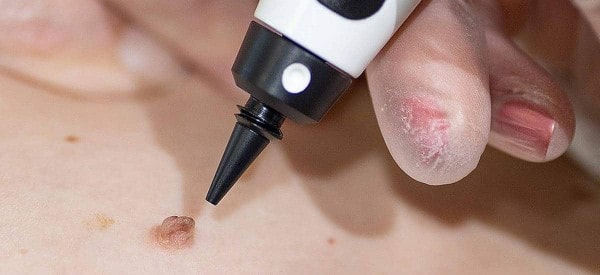 After Skin Tag Removal Basingstoke