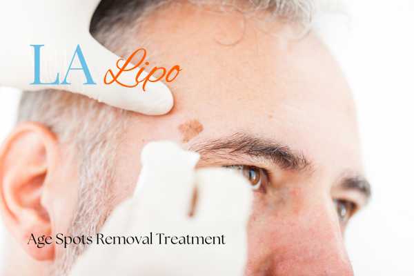 What Are the Most Effective Treatments for Age Spots Basingstoke?
