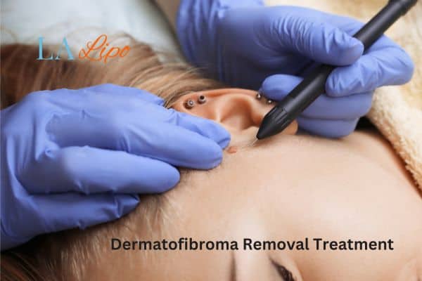 Dermatofibroma Removal Treatment Basingstoke