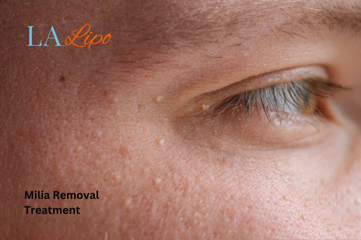 Cryopen Milia Removal: Is It the Easiest and Safest Option Basingstoke?