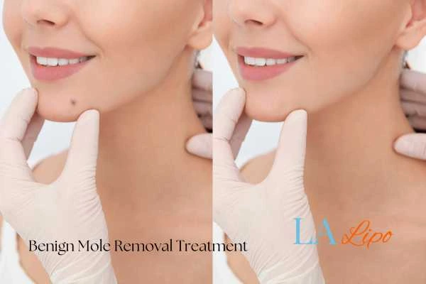 Before-and-after results following benign mole-removal treatment Basingstoke