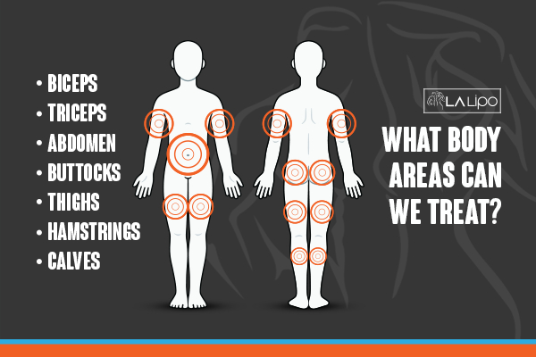 Graphic to show areas you can have LA-EMS Body Sculpting Basingstoke treatment.