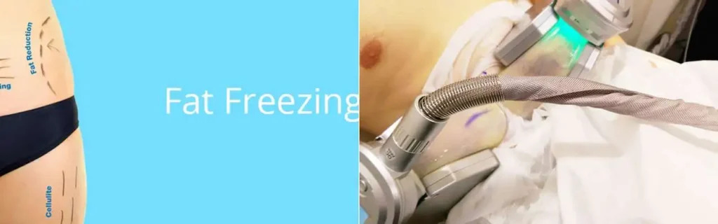 Fat freezing Basingstoke on multiple areas of the body
