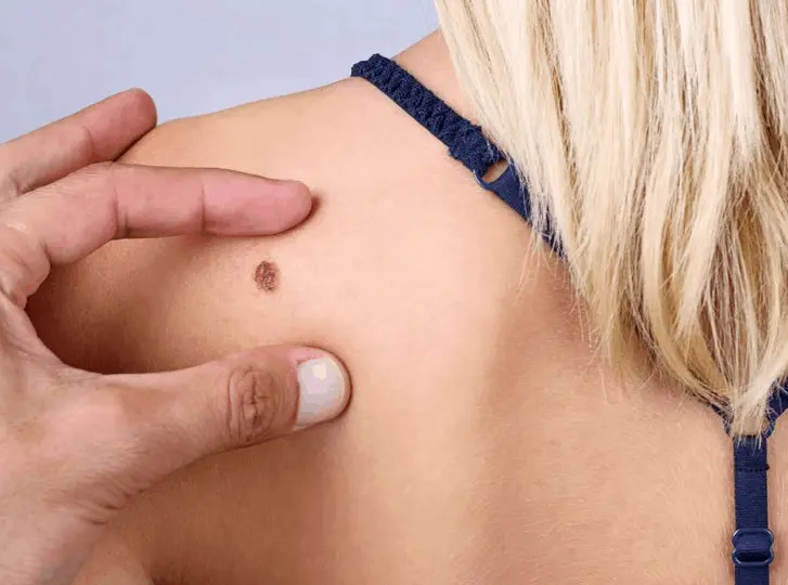 woman having mole removal Basingstoke consultation before treatment.