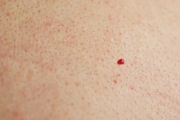 close up of a cherry angioma Basingstoke