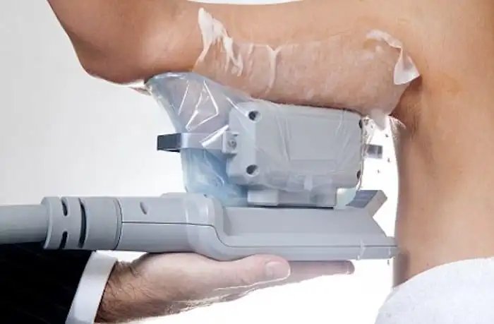 Picture of fat freezing Basingstoke on the upper arms.