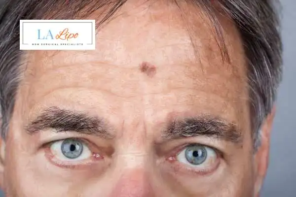 Solar Lentigo Removal Basingstoke image of man with mark on his forehead