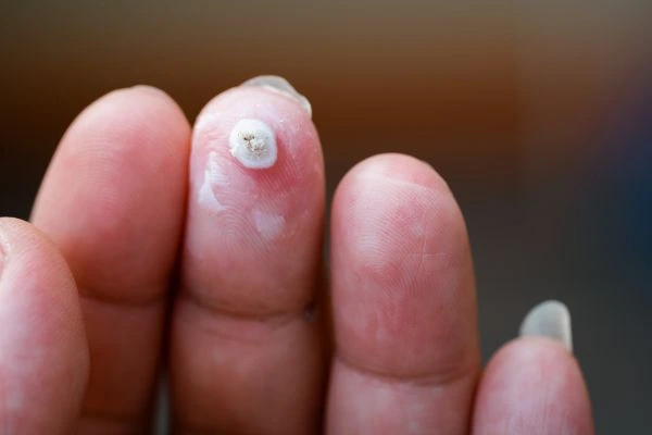 wart on person finger - cryotherapy to treat from LA LIPO Basingstoke