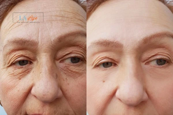 The powerful benefits of Morpheus8 Treatment Basingstoke - Call Our team today!