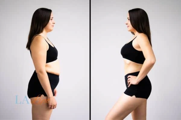 Picture of womans before and after using LA-EMS body sculpting to improve her core strength Basingstoke