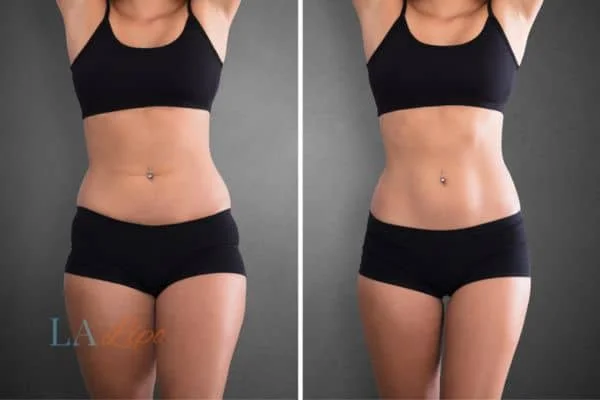 before and after results of non-surgical treatment to help a woman's body image and mental health Basingstoke