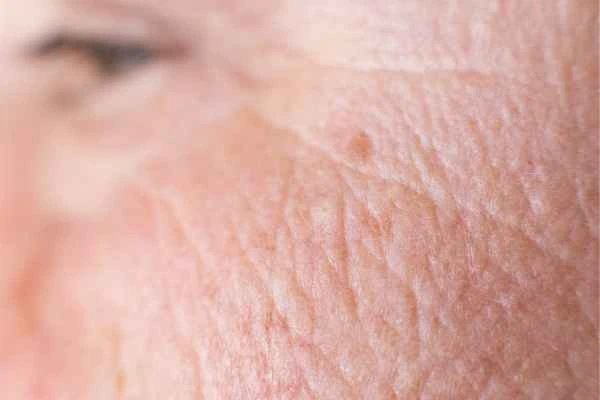 close up picture of a woman's face showing an age spot Basingstoke