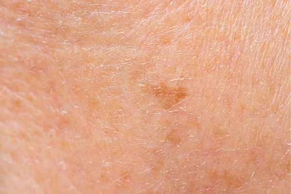 close up picture of age spots Basingstoke