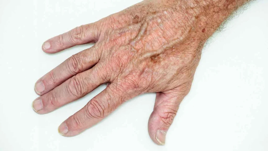 Male hand showing age spot Basingstoke