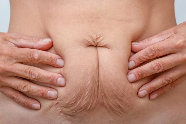 Should I Combine Diastasis Recti Treatment with Body Contouring for Better Results Basingstoke?
