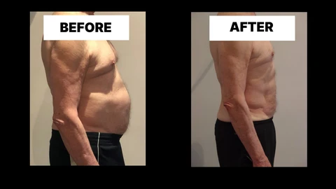 What Symptoms Can Diastasis Recti Cause in Men? Weak Core, Back Pain and Poor Posture Basingstoke